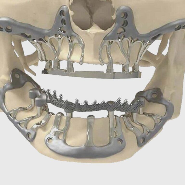 Implantes subperiósticos
